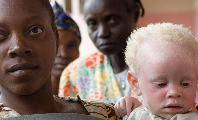 13 juin : Journée internationale de sensibilisation à l’albinisme 13 juin : Journée internationale de sensibilisation à l’albinisme - unchrd.org/